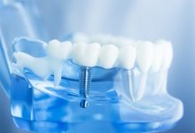 Reason Why We Need Mini Dental Implants