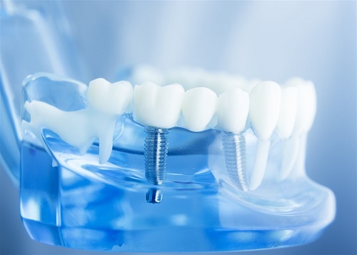 Reason Why We Need Mini Dental Implants