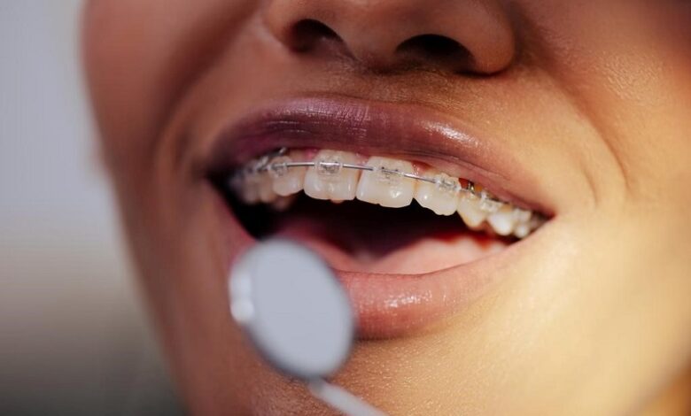 Different Kinds of Braces